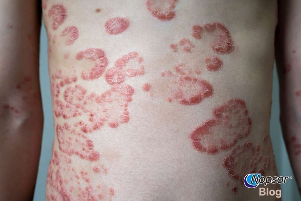 Beyond Skin Deep: The Hidden Challenges of Living with Psoriasis