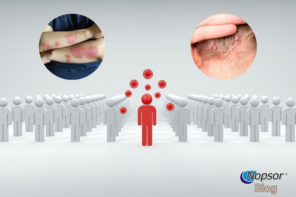 Breaking the Stigma: Understanding That Psoriasis Isn’t Contagious