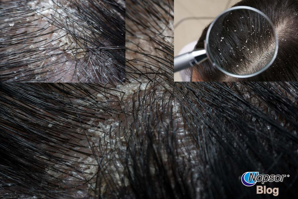 Dandruff or Dry Scalp: How to Tell the Difference