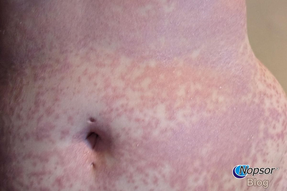 Erythrodermic Psoriasis: Why It’s a Medical Emergency