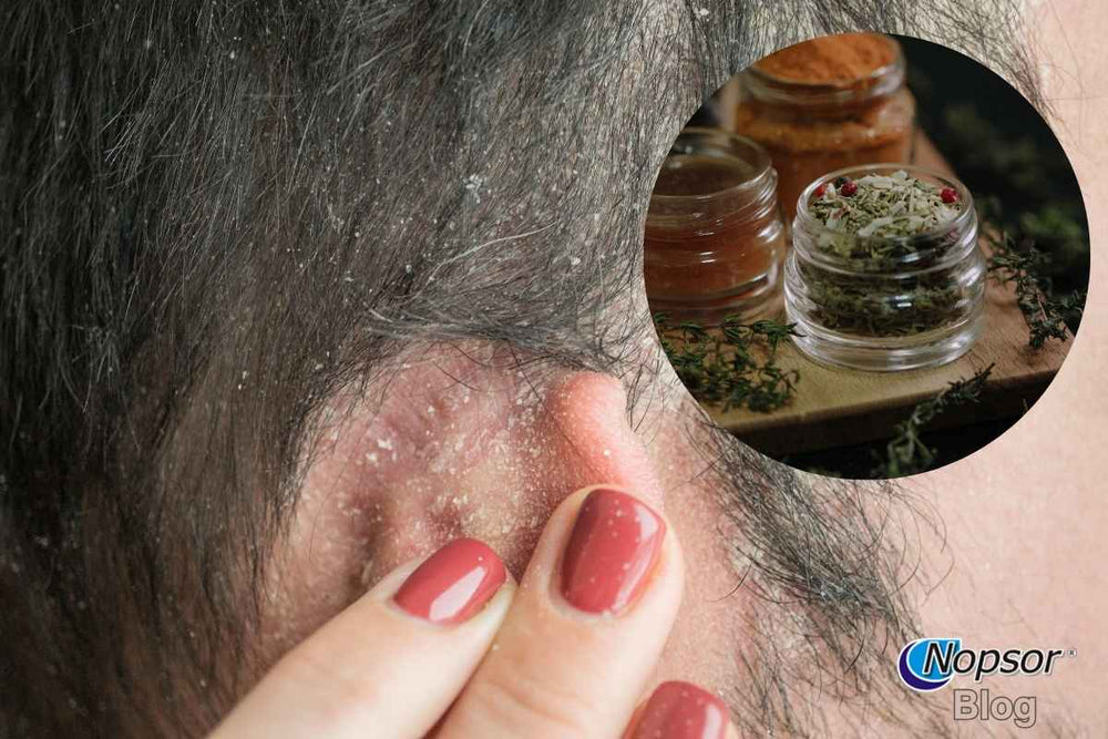 Home Remedies for Scalp Psoriasis: Natural Solutions for Relief