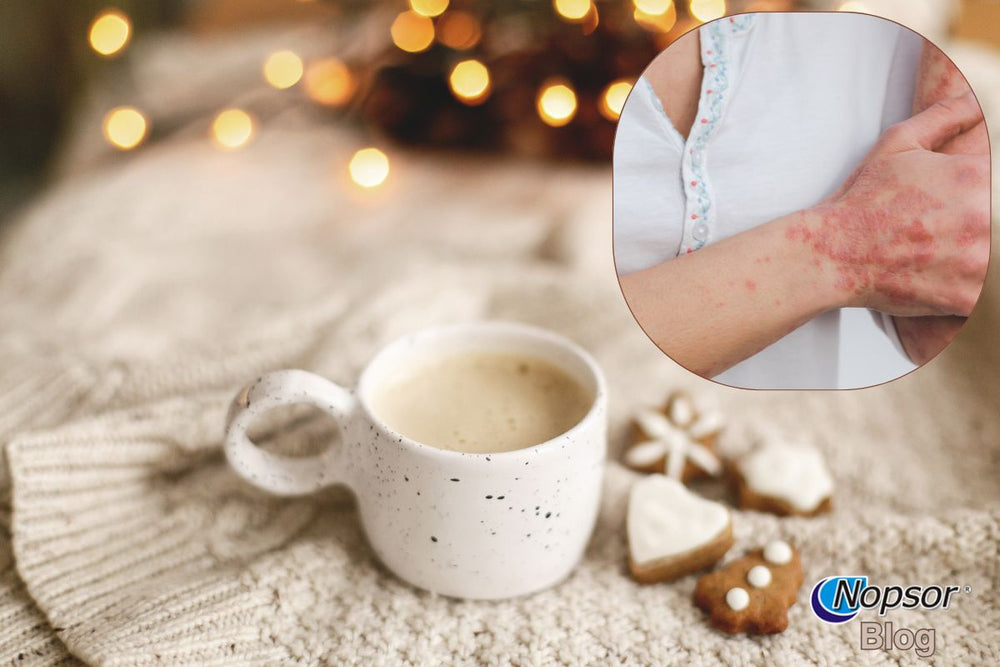 How Cold Weather Affects Psoriasis and Tips to Cope