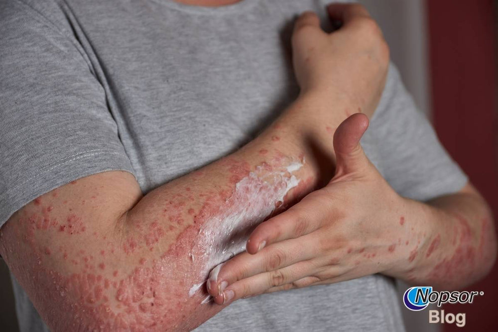 How to Build a Psoriasis-Friendly Skincare Routine