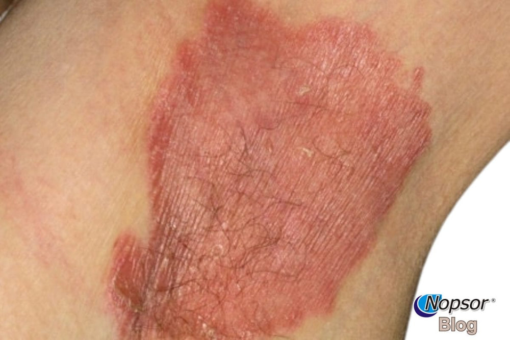 Inverse Psoriasis: Causes, Symptoms, and Best Treatments