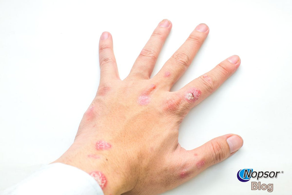 Living with Palmoplantar Psoriasis: Work, Shoes & Daily Life Tips