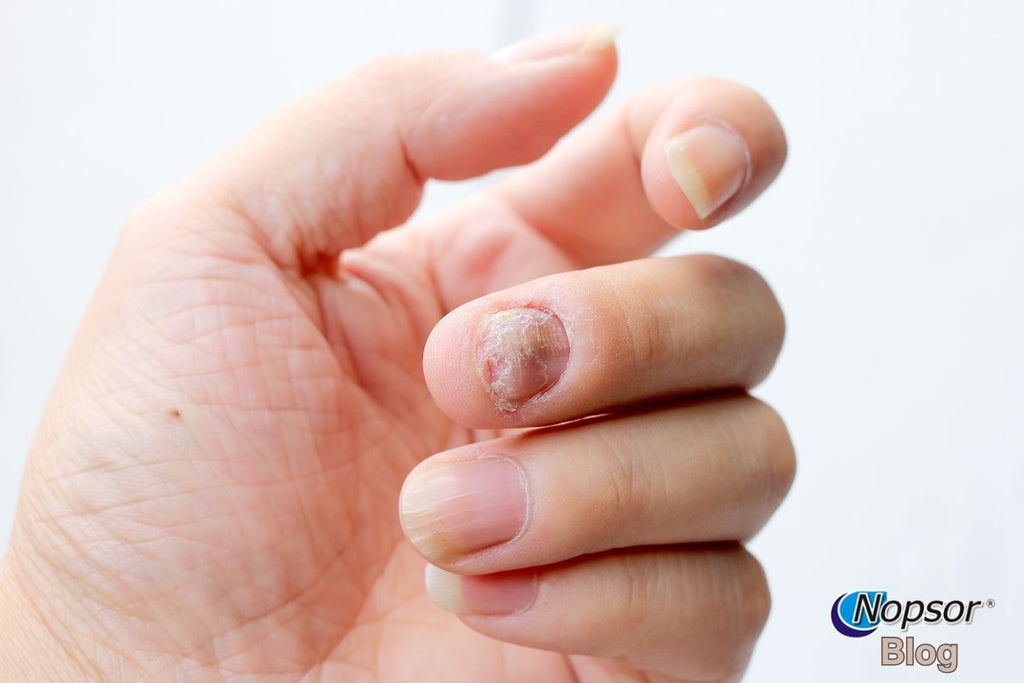Nail Psoriasis: Symptoms, Treatments, and Nail Care Tips