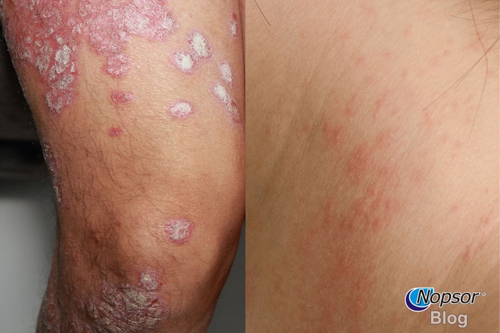 Psoriasis vs. Eczema: Understanding the Differences