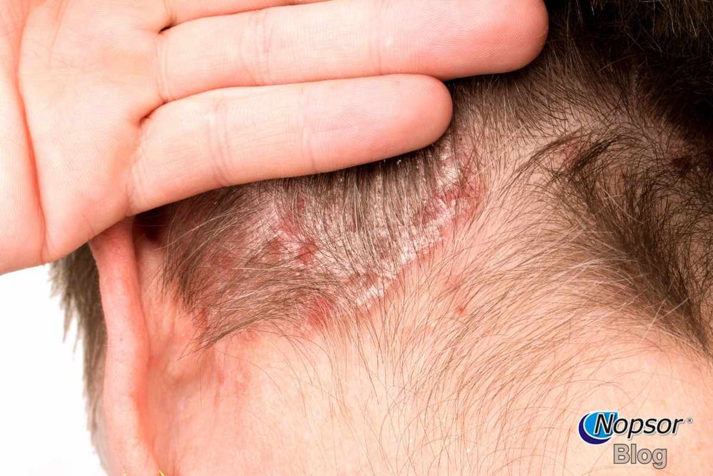 Scalp Psoriasis: Causes, Treatments, and Home Remedies