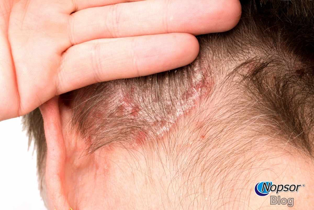 Scalp Psoriasis: Causes, Treatments, and Home Remedies