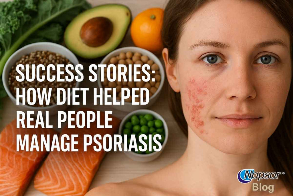 Success Stories: How Diet Helped Real People Manage Psoriasis