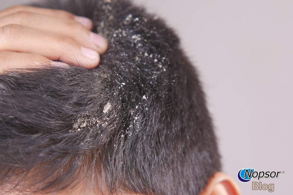 The Best Dandruff Shampoos for Sensitive Skin