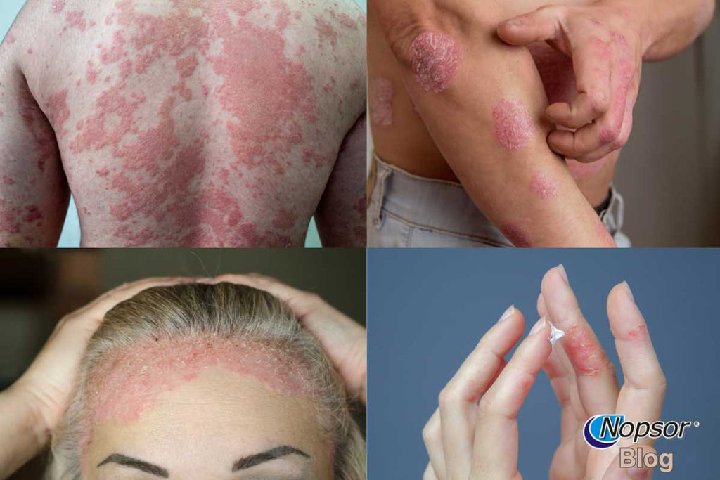 Types of Psoriasis: How to Identify and Manage Each One