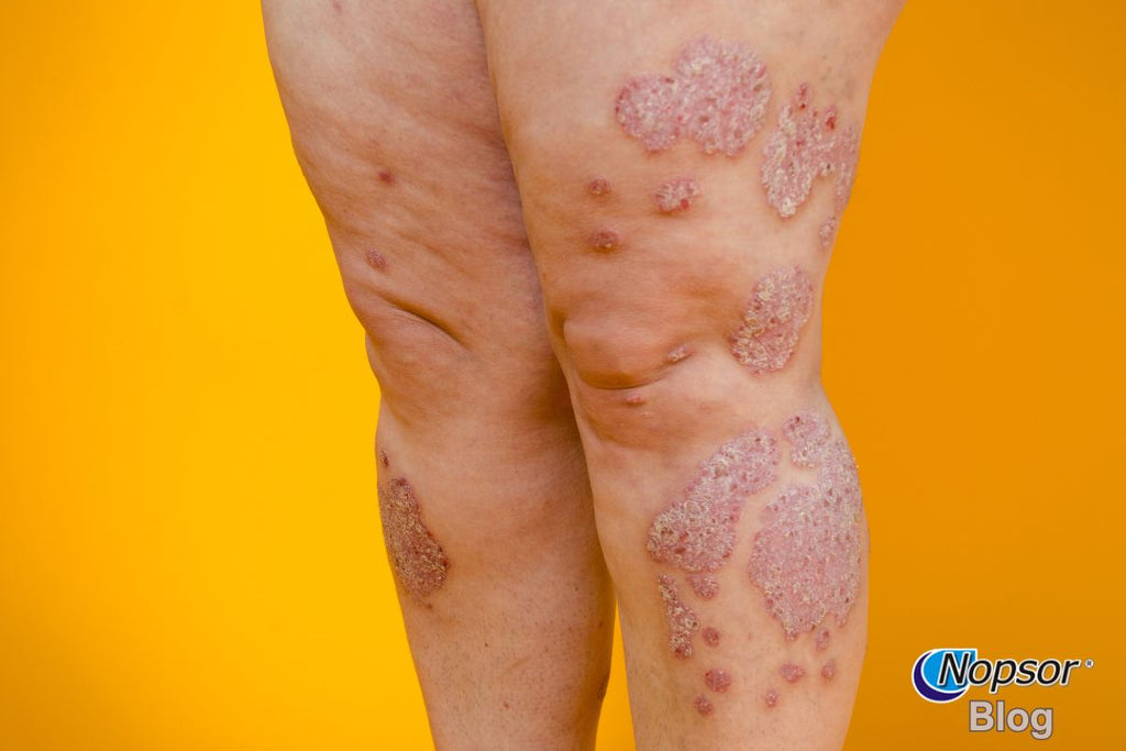 Types of Psoriasis Plaque, Guttate, and More