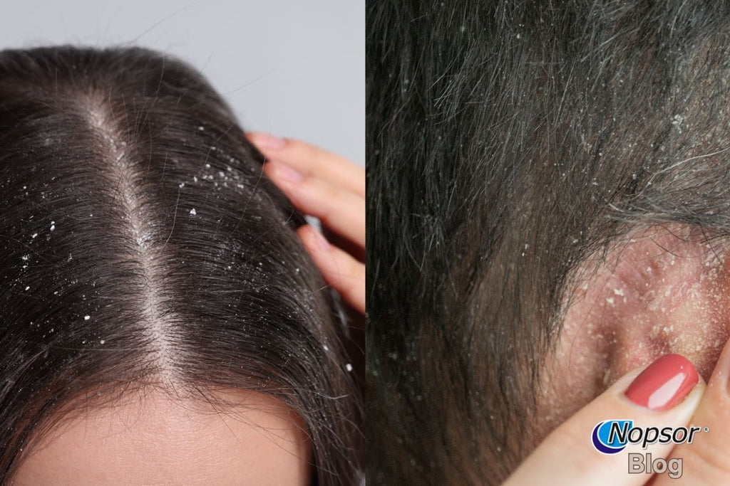 Visual Guide: What Dandruff and Dry Scalp Look Like