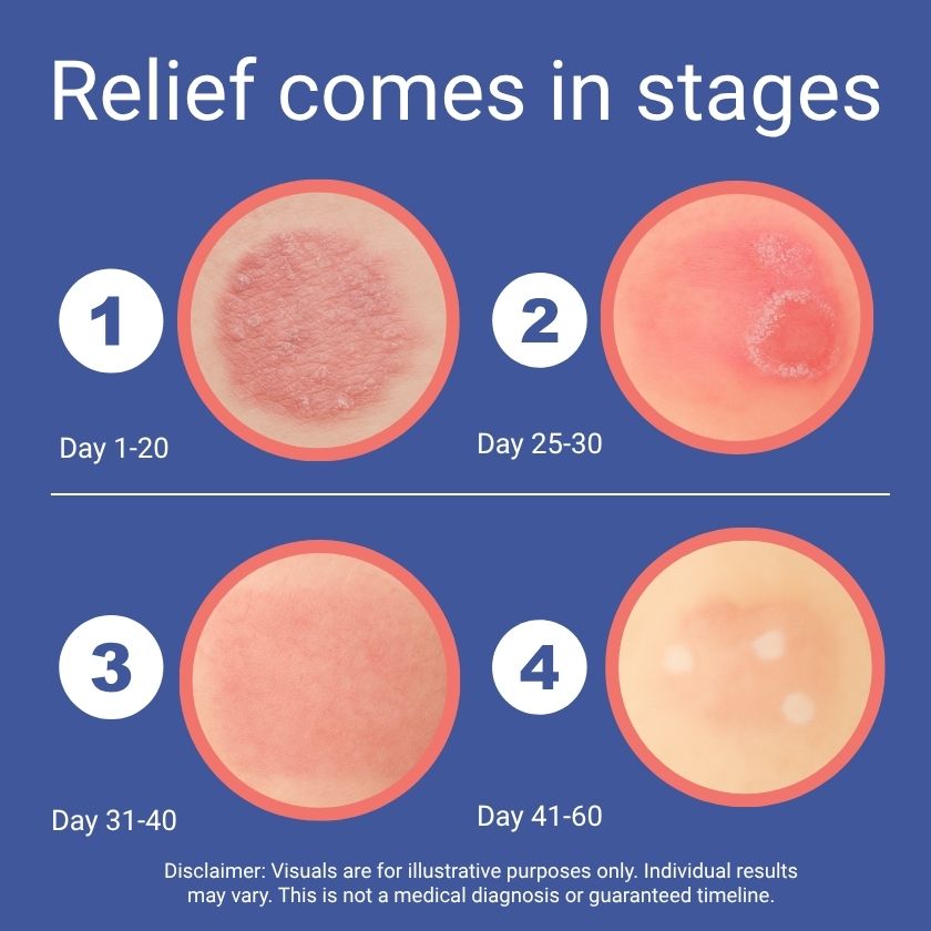Illustration showing stages of skin relief over time with a blue background.