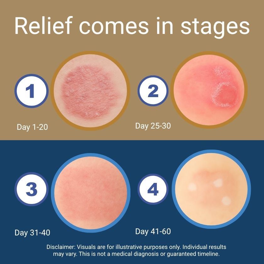 Illustration showing stages of skin relief over time with text 'Relief comes in stages'.