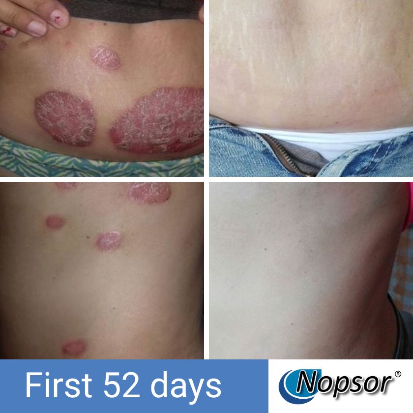 Before and after comparison of skin conditions on a person's body with Nopsor branding.