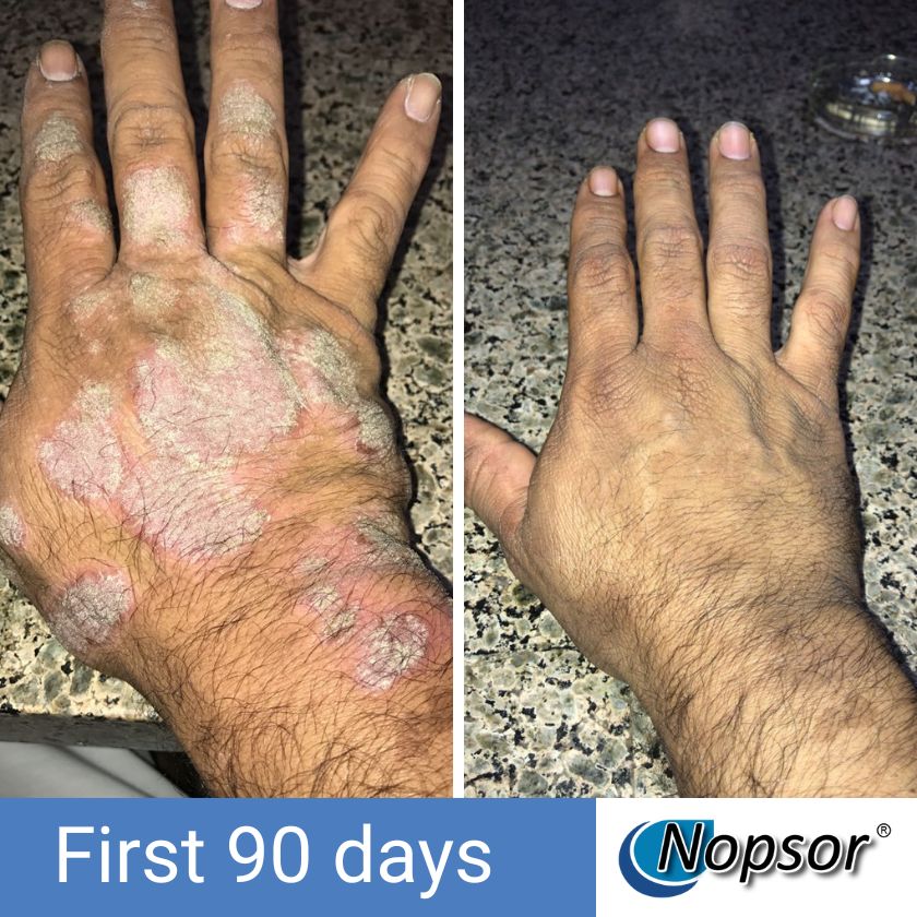 Before and after comparison of a hand with psoriasis treated with Nopsor, showing visible improvement over 90 days.