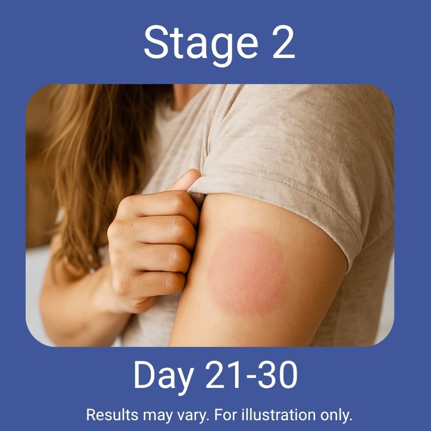 Person with a red mark on their arm, labeled 'Stage 2' and 'Day 21-30', on a blue background.