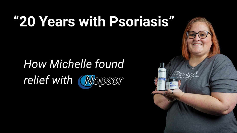 Michelle’s 20-Year Journey with Psoriasis: Finding Relief with Nopsor