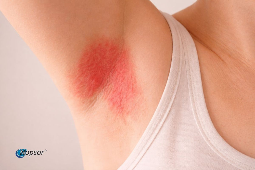 Red rash on a person's shoulder with 'Nopsor' branding.