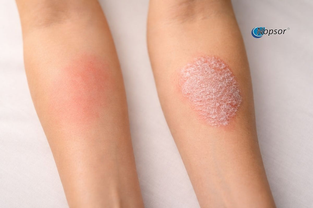 Psoriasis or Skin Allergy? How to Tell the Difference | Nopsor