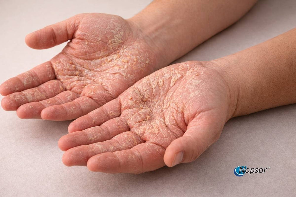 Close-up of two hands with psoriasis on a neutral background