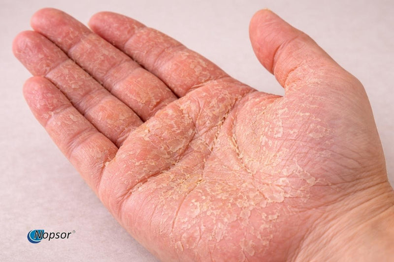 Hand with visible skin condition on a plain background