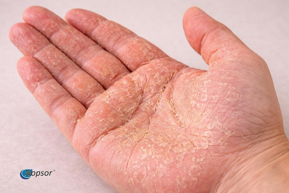 Hand with visible skin condition on a plain background