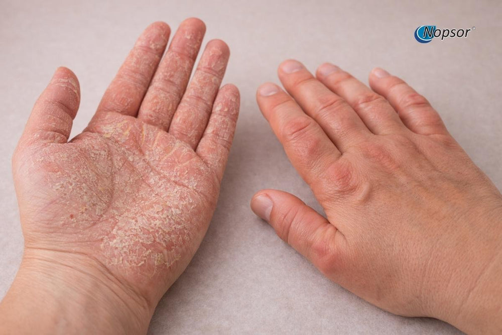 Illustration of palmoplantar psoriasis on a hand and foot with Nopsor branding.