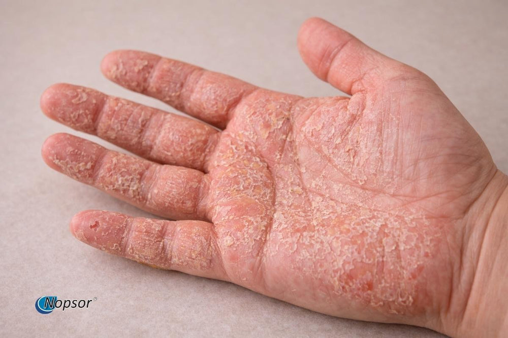 Palmoplantar Psoriasis vs. Palmoplantar Pustulosis: Spot the Difference.