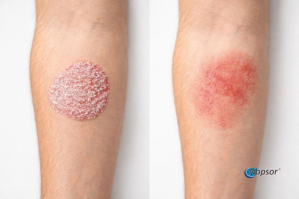 Two skin conditions on a person's legs with 'Nopsor' branding.