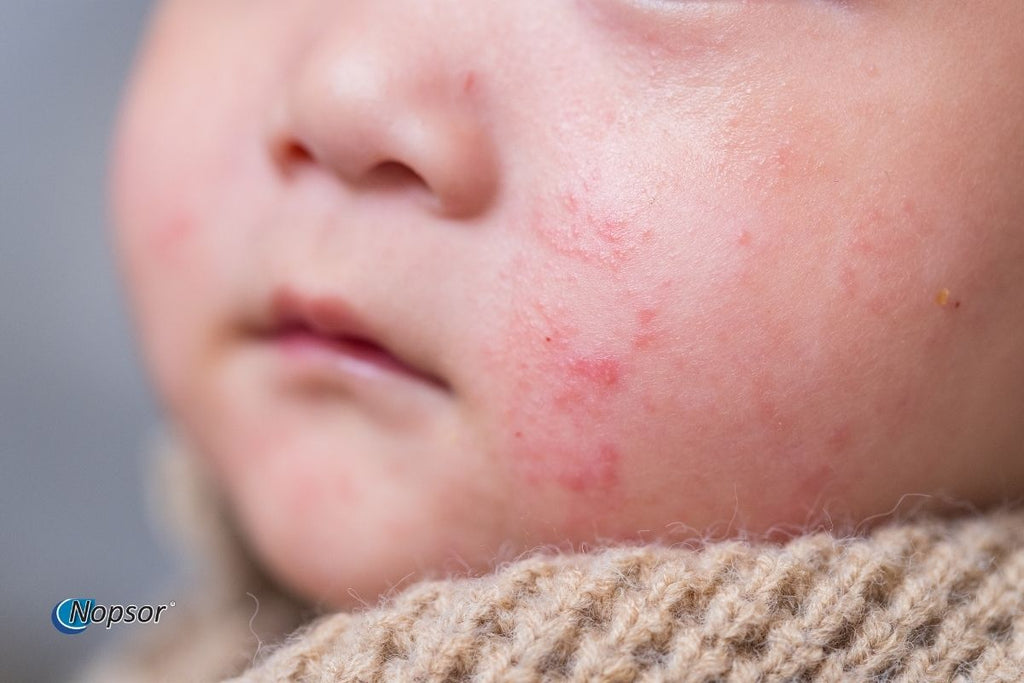 Close-up of a child's face with redness on the cheek, possibly due to eczema or allergies.