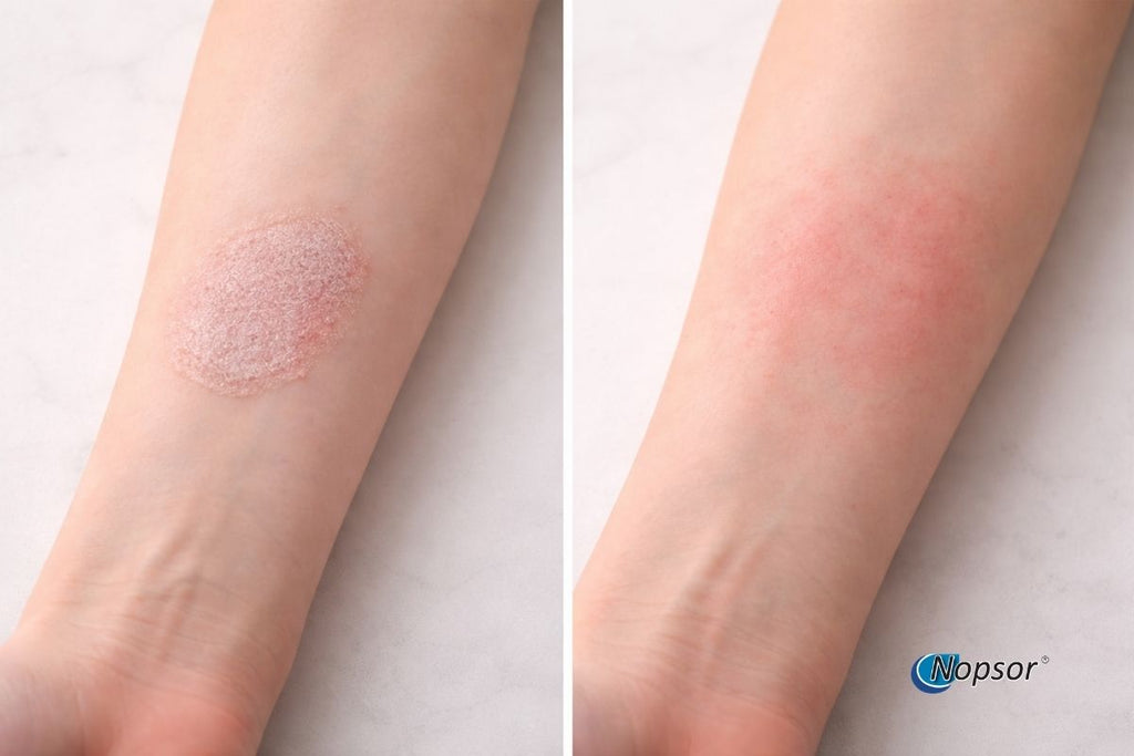Comparison of skin with and without a rash on a light background, featuring the Nopsor brand.