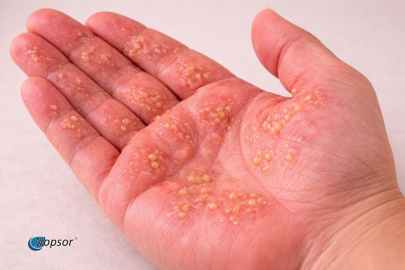 Hand with small lesions on a white background