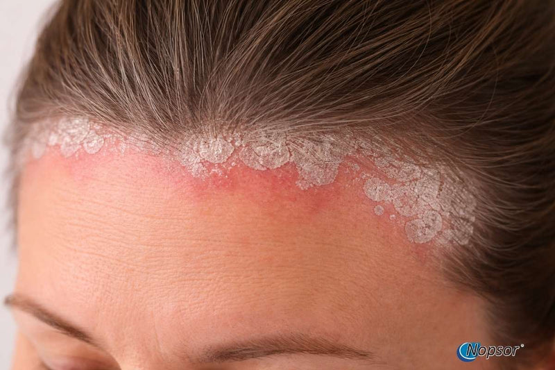 Close-up of a person's scalp with foamy shampoo application and visible Nopsor logo.