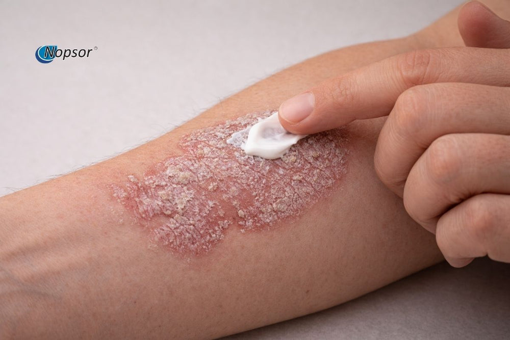 Person applying a cream to a psoriasis patch on their arm with Nopsor branding.