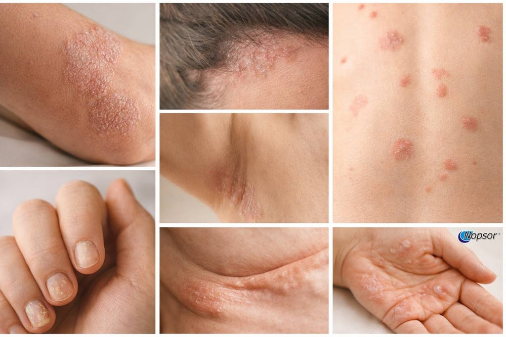 Types of Psoriasis: How to Identify Each One | Nopsor