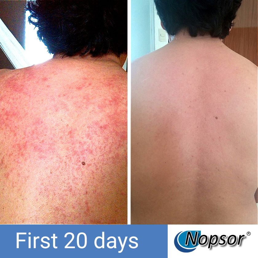 Before and after comparison of a person's back with Nopsor treatment showing improvement.
