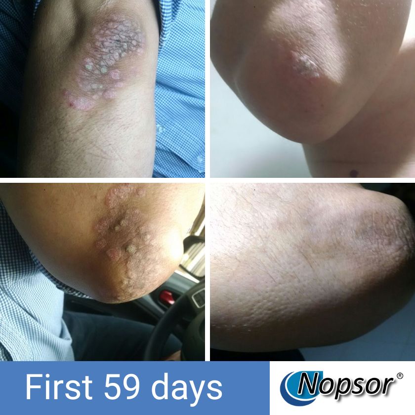 Collage of skin conditions before and after treatment with Nopsor, showing a person's arm with lesions over the first 59 days.