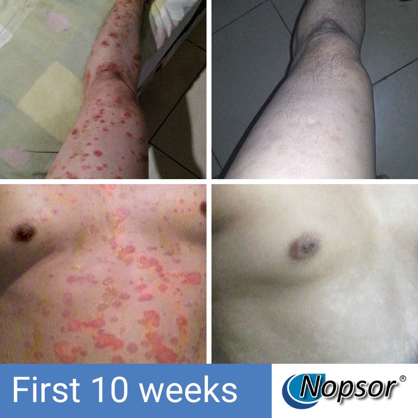 Collage of skin conditions on different body parts with 'Nopsor' branding.