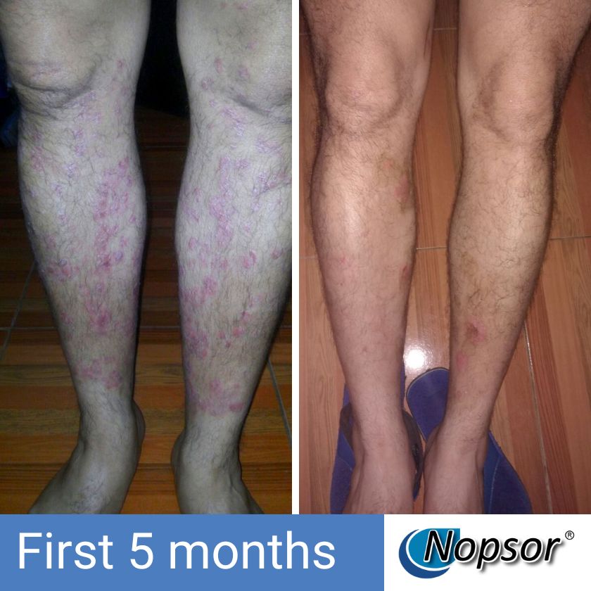 Before and after comparison of legs with Nopsor treatment showing improvement over first 5 months.