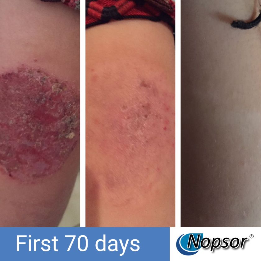 Progression of a skin condition over the first 70 days with Nopsor branding.