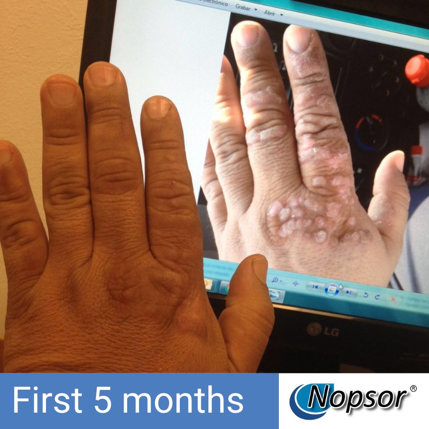 Two hands, one with dark skin and the other with lighter skin, held up to a screen displaying 'Nopsor'.