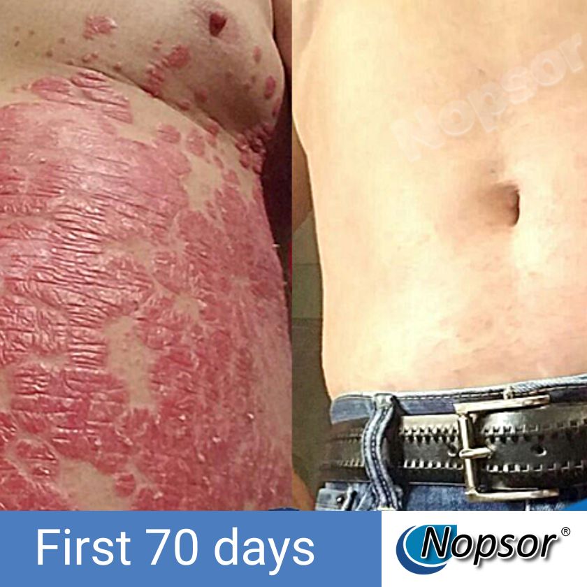 Before and after comparison of skin condition with Nopsor logo and 'First 70 days' text.