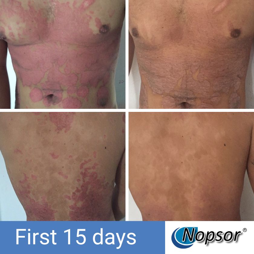 Before and after treatment of skin conditions on a person's torso with Nopsor branding.