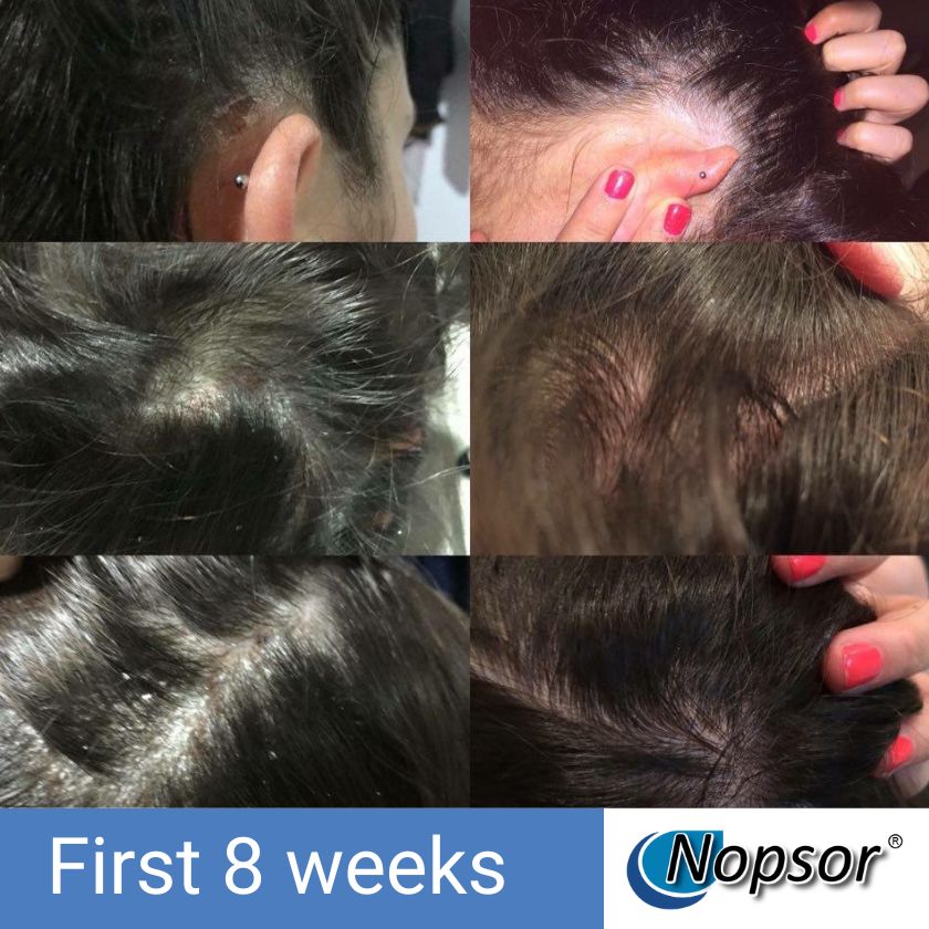 Collage of hair conditions with 'Nopsor' branding and text indicating 'First 8 weeks'.