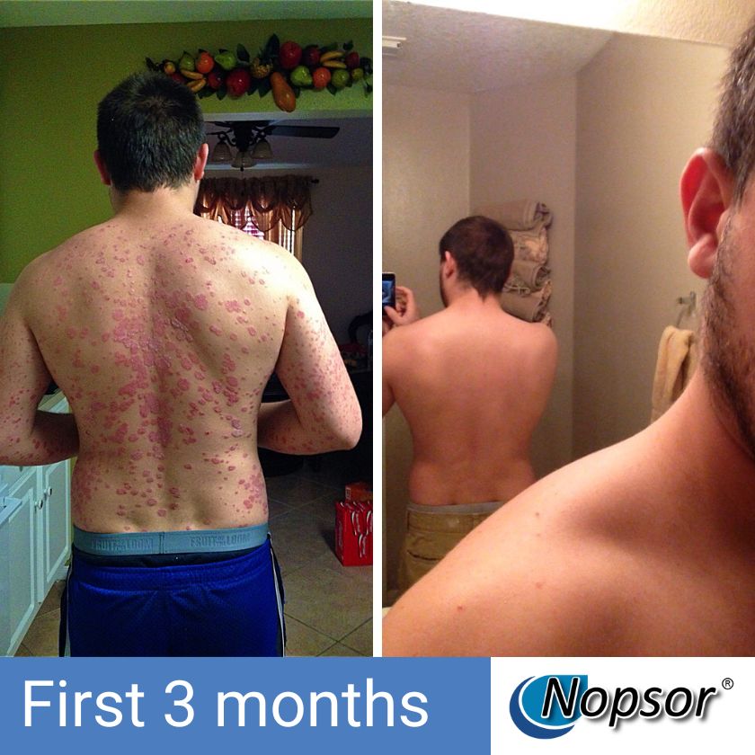 Before and after comparison of a man's back with visible rashes, showing improvement over the first three months with Nopsor.