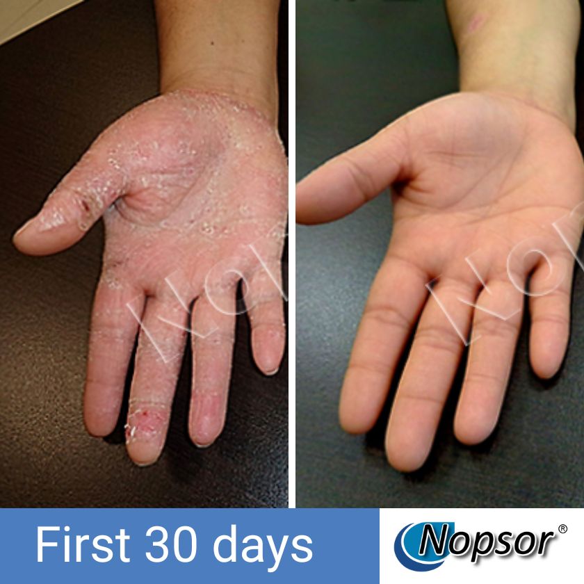 Before and after comparison of a child's hand with Nopsor treatment showing improvement over 30 days.