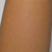 Close-up of a psoriasis lesion
